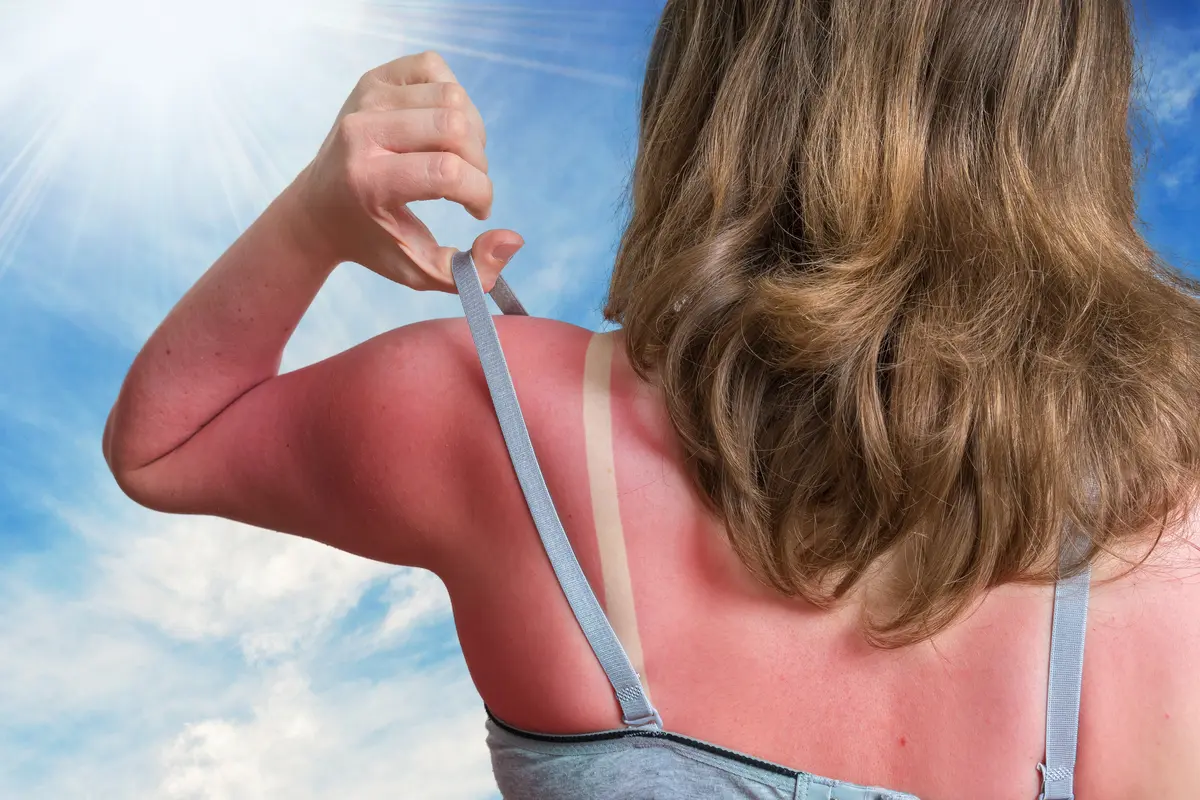 Sunburn Sunburn